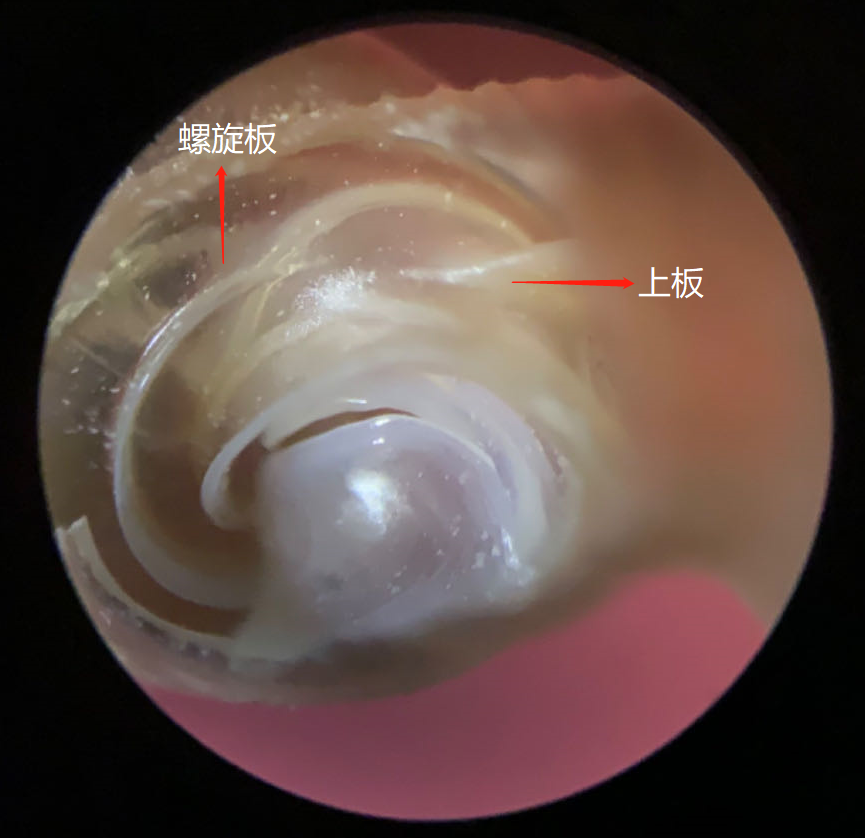上板和螺旋版相对位置